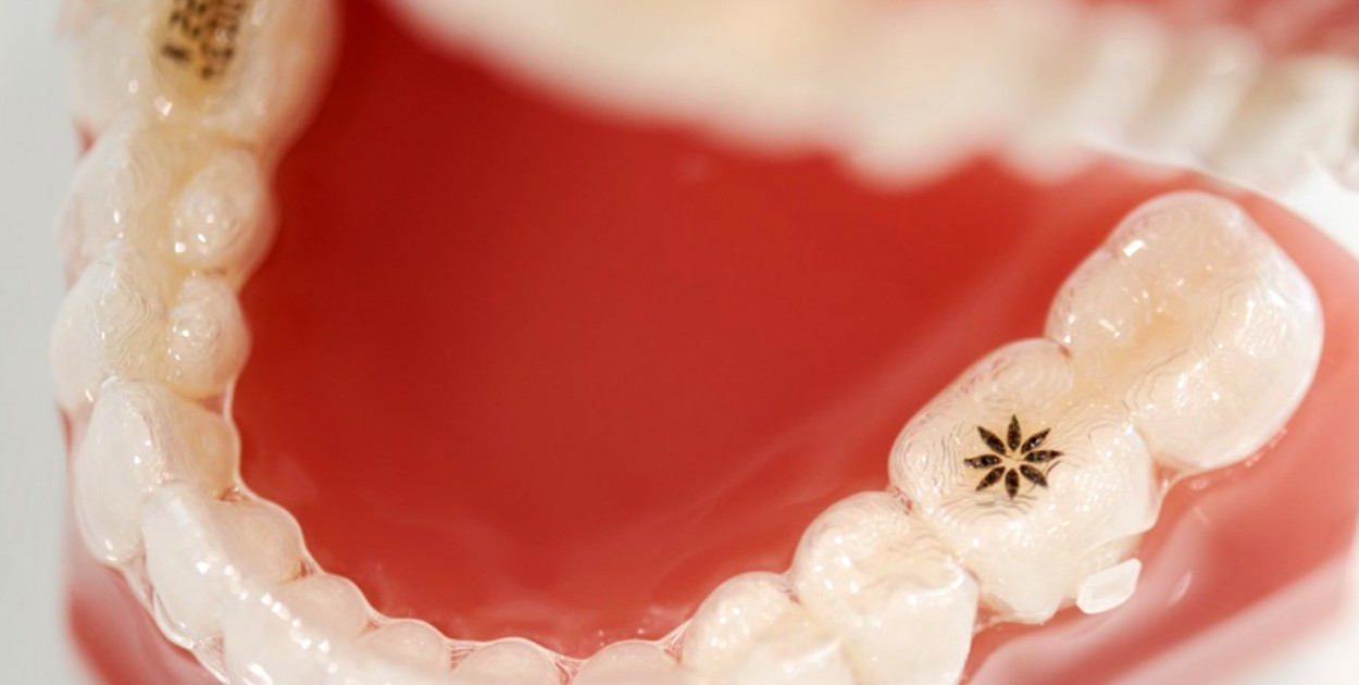 Ortodoncja – aparaty ortodontyczne nakładkowe. Jak to działa?